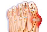 Load image into Gallery viewer, The Bunion Relief and Forefoot Protector Brace "Pair"
