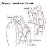 Load image into Gallery viewer, The Bunion Relief and Forefoot Protector Brace "Pair"