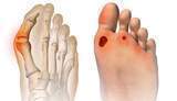 Load image into Gallery viewer, The Bunion Relief and Forefoot Protector Brace "Pair"