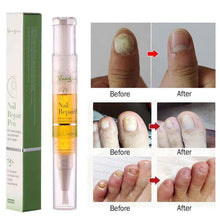 Load image into Gallery viewer, Advanced Fungal Nail Repair Pen