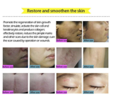 Load image into Gallery viewer, Acne Scar Removal Cream
