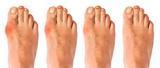 Load image into Gallery viewer, The Bunion Relief and Forefoot Protector Brace &quot;Pair&quot;
