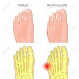 Load image into Gallery viewer, The Bunion Relief and Forefoot Protector Brace &quot;Pair&quot;
