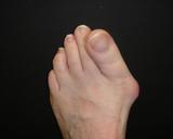 Load image into Gallery viewer, The Bunion Relief and Forefoot Protector Brace &quot;Pair&quot;
