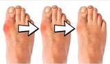 Load image into Gallery viewer, The Bunion Relief and Forefoot Protector Brace &quot;Pair&quot;
