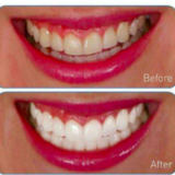 Load image into Gallery viewer, Instant Teeth Whitening Pen
